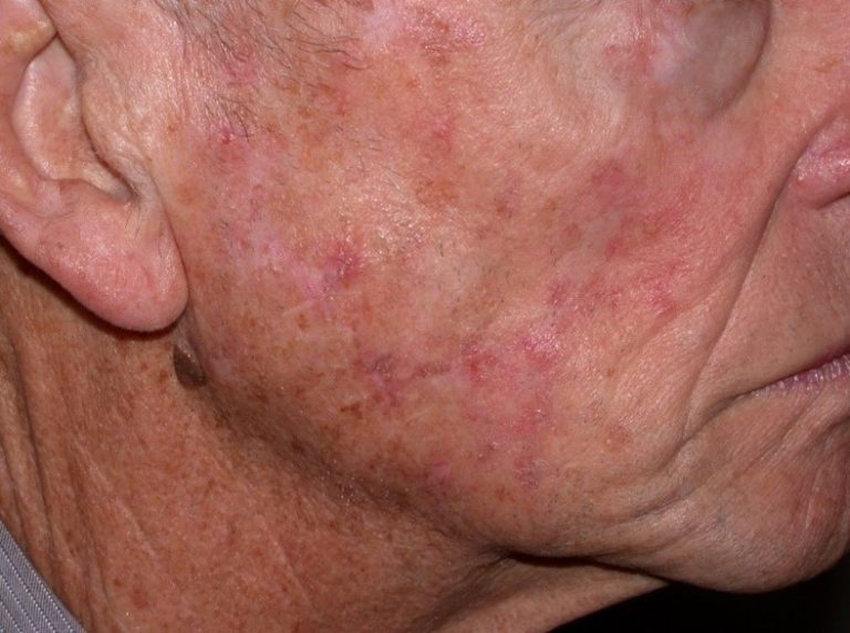 Actinic Keratosis Diagnosis And Treatments Run To Win