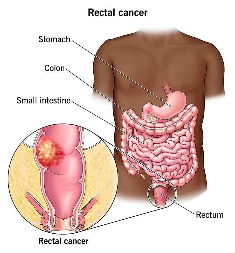 Anal Cancer Symptoms Causes Risk Factors And Complications Run