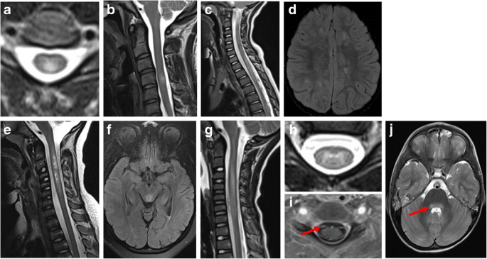 Acute Flaccid Myelitis (AFM): Symptoms, Causes And Risk Factors - Run ...