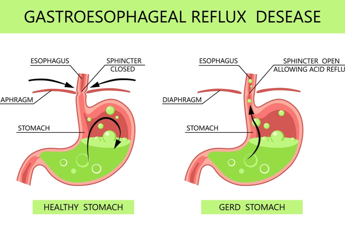 Gastroesophageal Reflux Disease (GERD) Symptoms, Causes,risk Factors ...