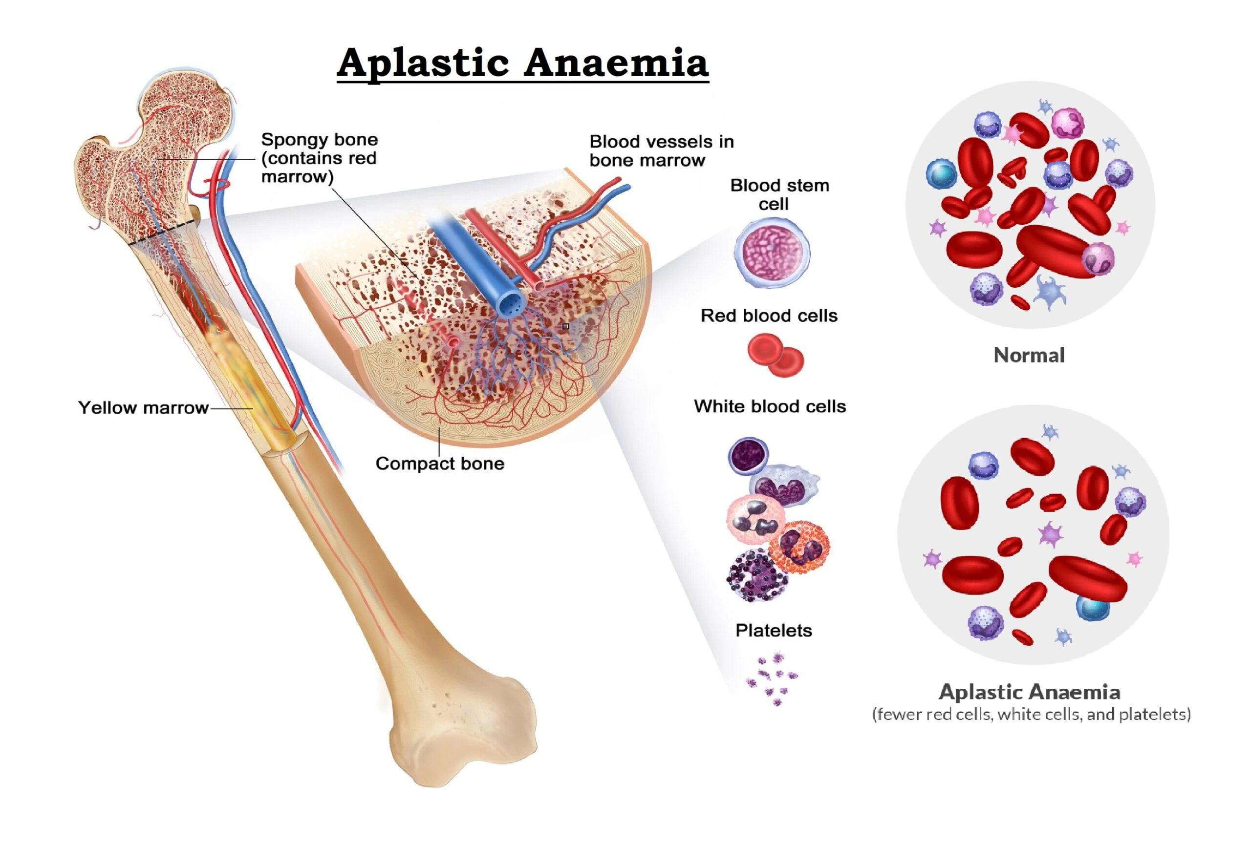 anemia-symptoms-causes-risk-factors-and-complications-run-to-win